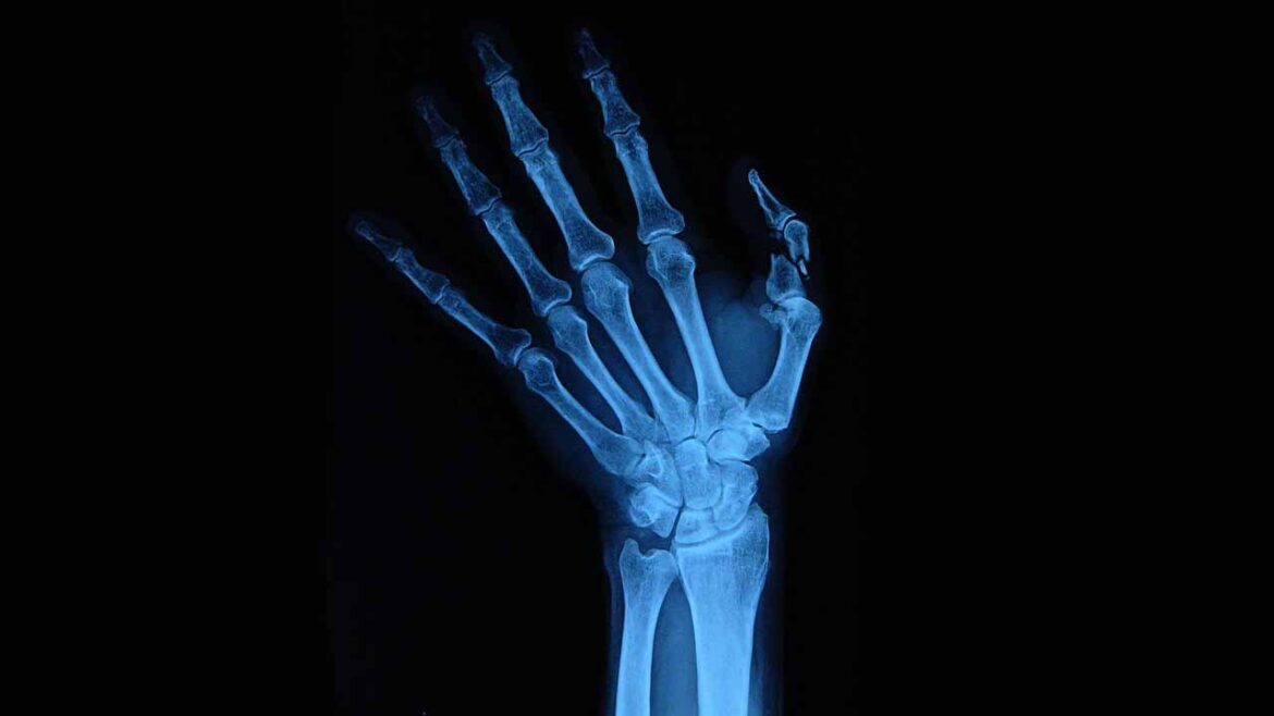 what-is-carpal-tunnel-syndrome-symptoms-treatment what-is-carpal-tunnel-syndrome-symptoms-treatment